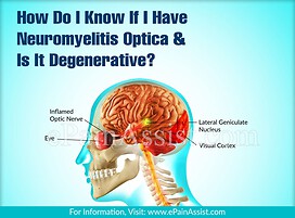 How Do I Know If I Have Neuromyelitis Optica