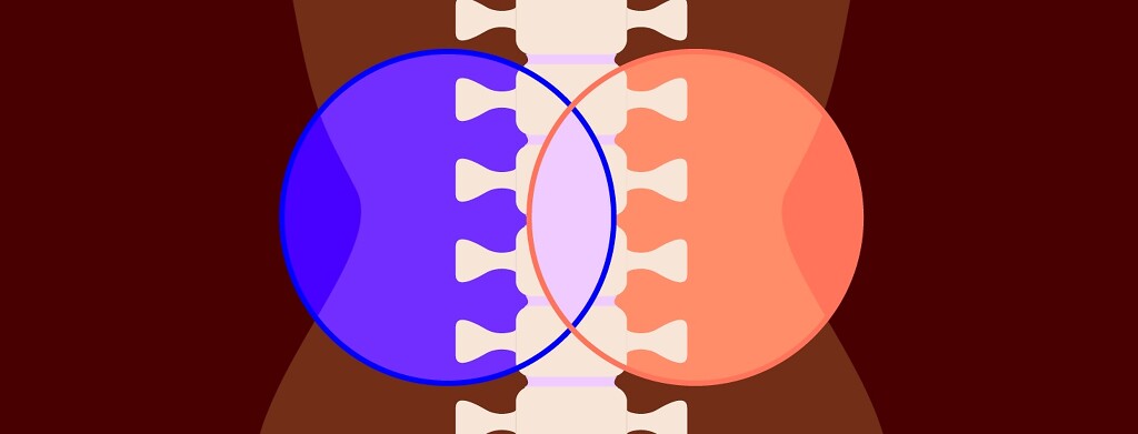 a venn diagram of nom and lupus overlaps the spinal cord