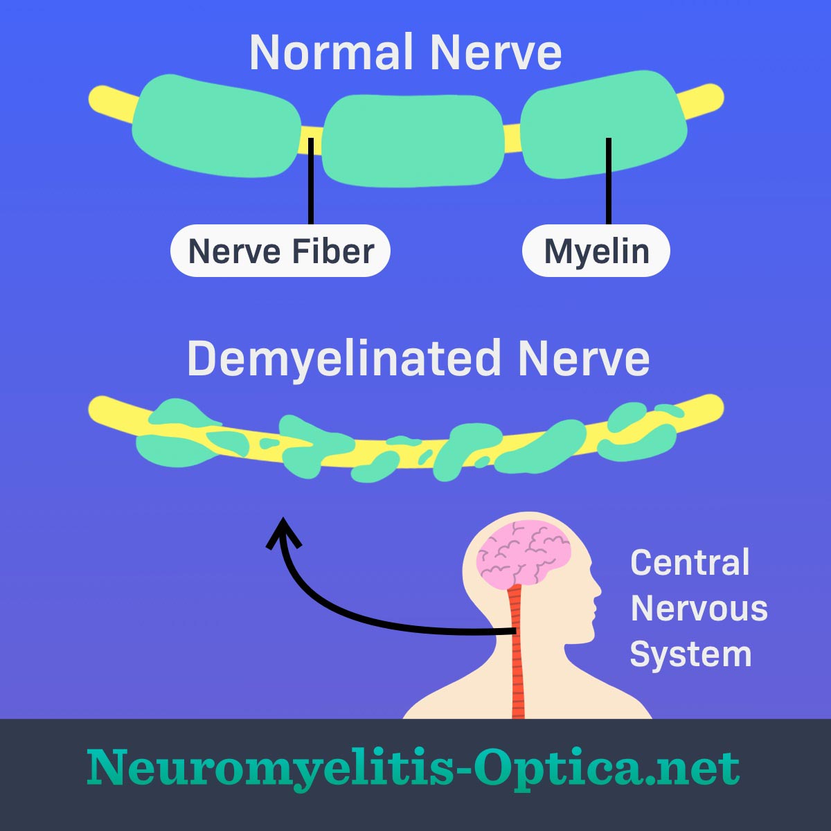 Two nerve images are shown, one depicting a nerve with normal myelin and another depicting a nerve with demyelination.