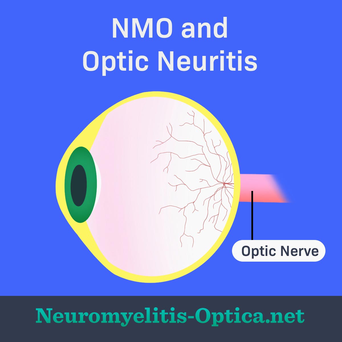 Image of eyeball highlighting the optic nerve which is affected by NMO.