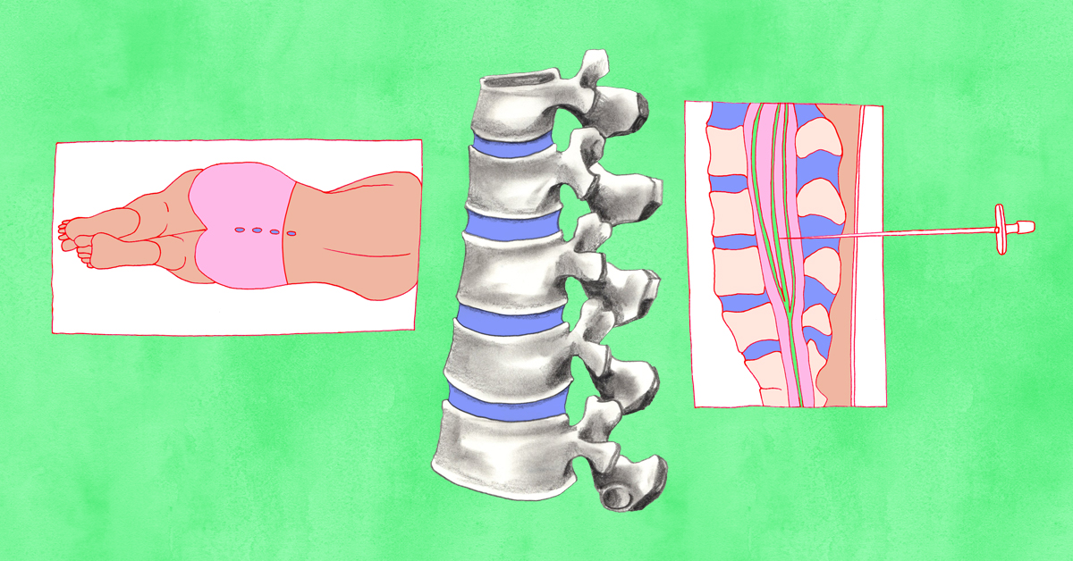 My Tips After Getting My First Spinal Tap For NMOSD